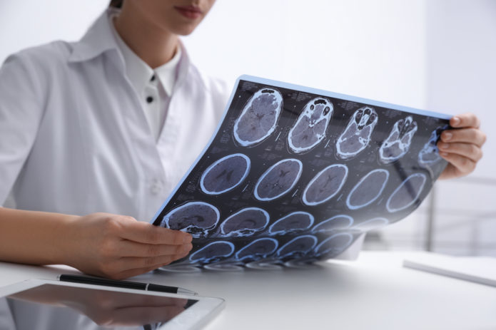 sclerosis multiplex