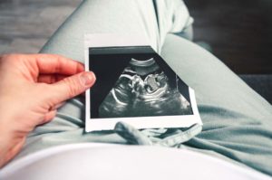 PCOS esetén megnőhet a vetélés esélye.