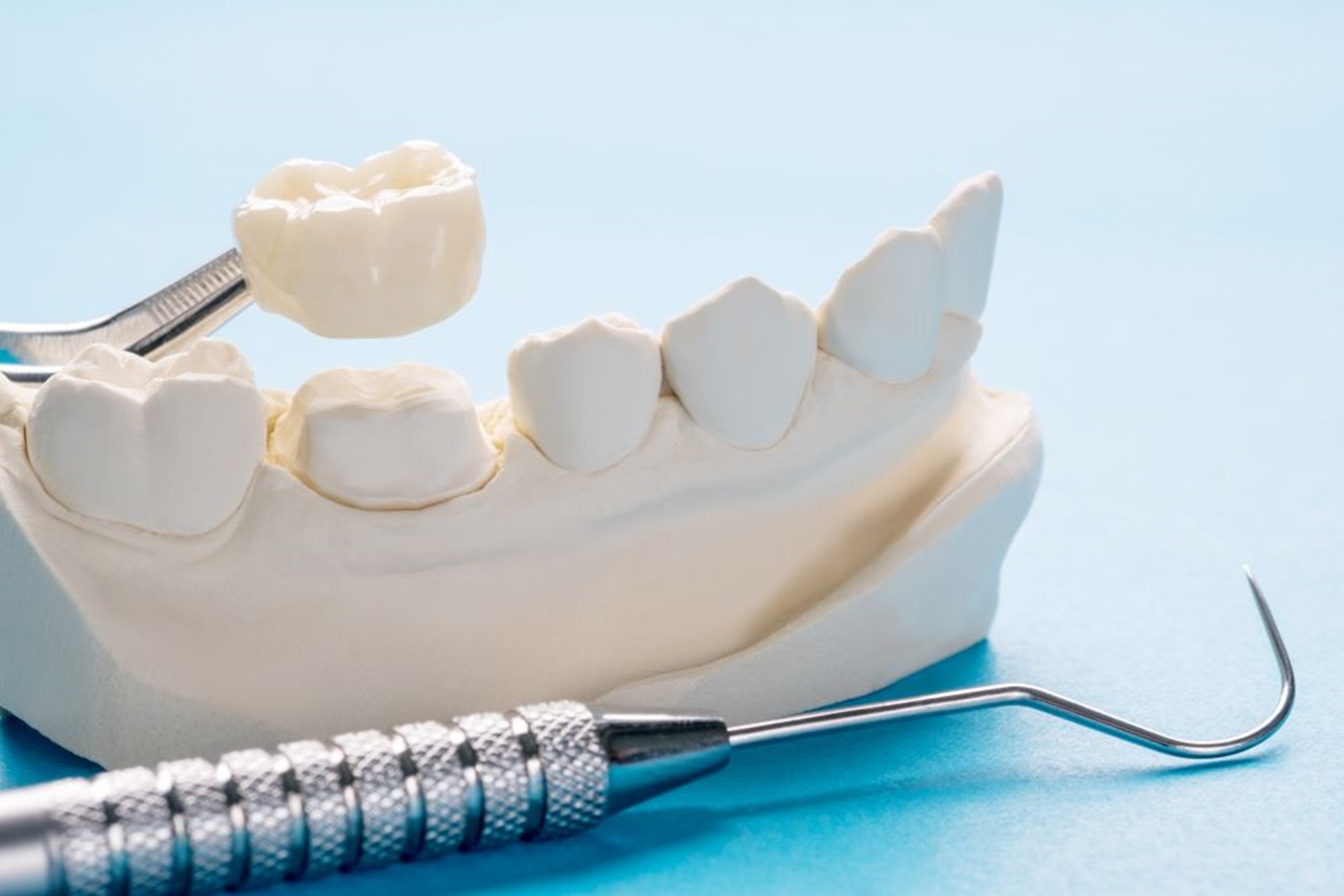 fémmentes koronák, implantátum fémmentes koronák